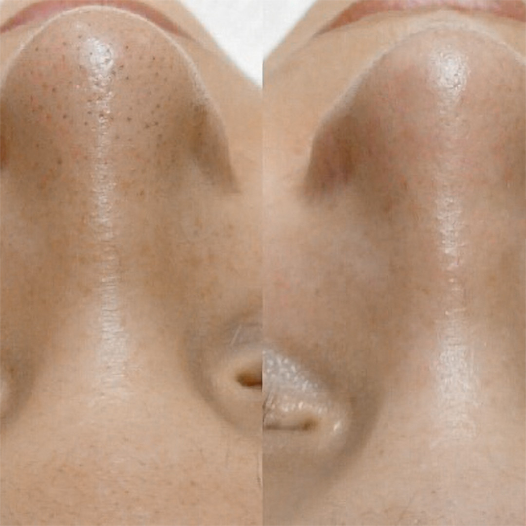 Маска 3 в 1 для видалення чорних точок BIOAQUA Three Step Curved